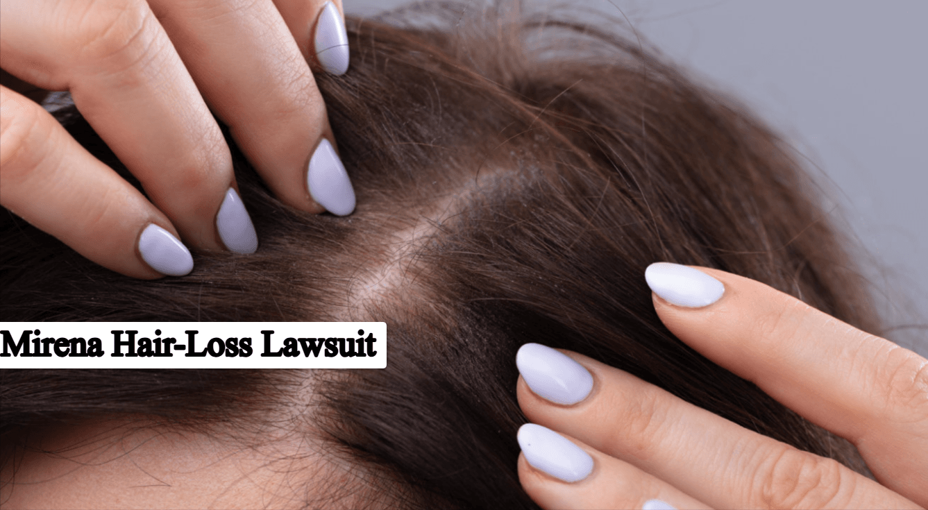 Mirena Hair-Loss Lawsuit: Complete Overview